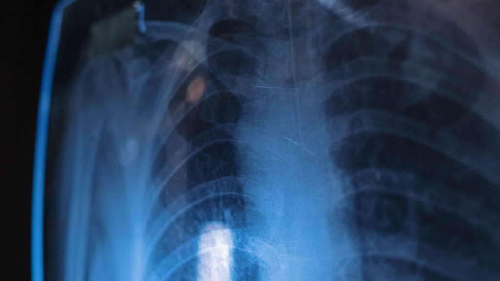 Close-up of a chest X-ray film held up to the light, showing the ribcage and both lung fields.