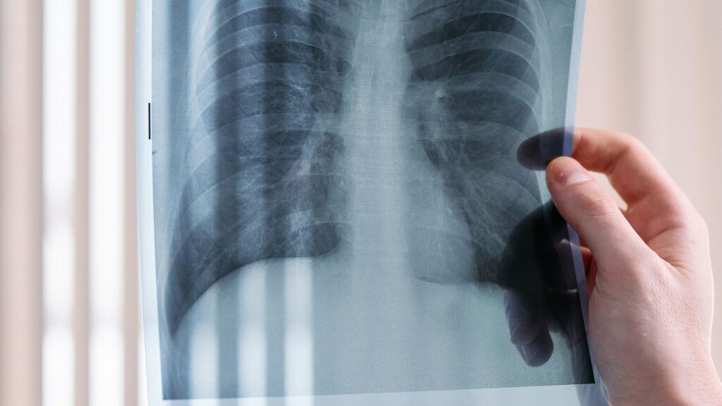 Is Pulmonary Rehab Safe and Does It Help With Pulmonary Fibrosis or ILD?